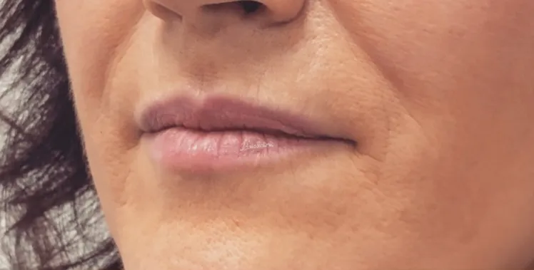 Preenchimento labial 2 Antes